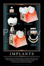 Load image into Gallery viewer, Implants Wall Chart