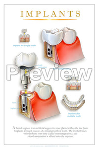 Implants Wall Chart