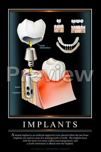 Implants #2 Wall Chart