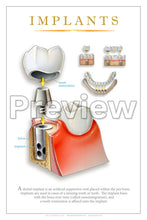 Load image into Gallery viewer, Implants #2 Wall Chart