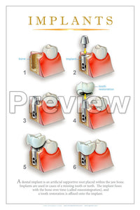 Implants #3 Wall Chart