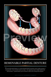 Removable Partial Denture Wall Chart
