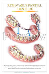 Removable Partial Denture Wall Chart