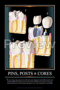 Pins, Posts & Cores Wall Chart