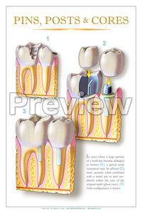 Pins, Posts & Cores Wall Chart