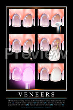 Load image into Gallery viewer, Veneers Wall Chart