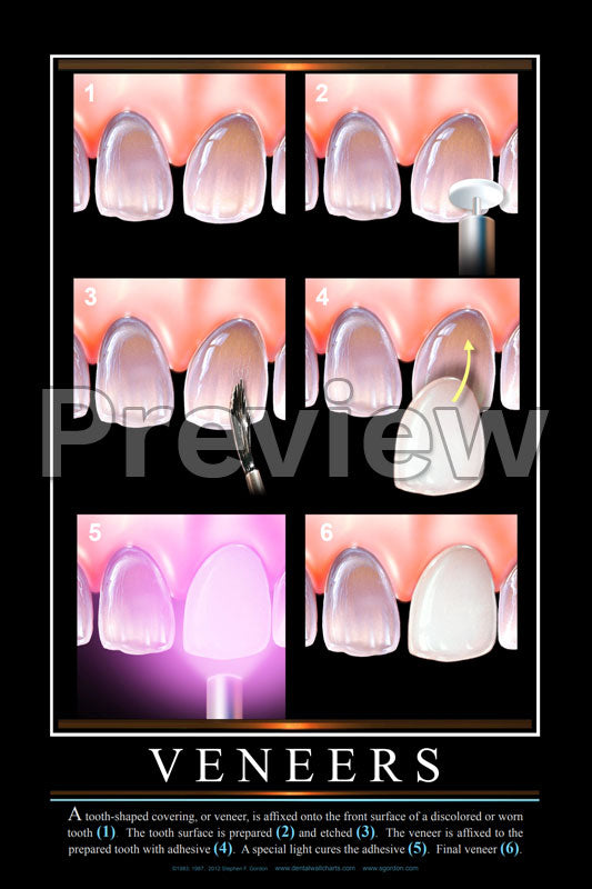 Veneers Wall Chart
