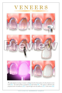 Veneers Wall Chart