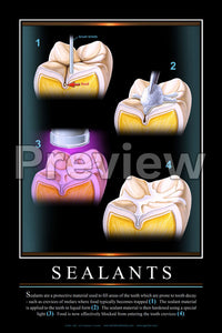 Sealants Wall Chart