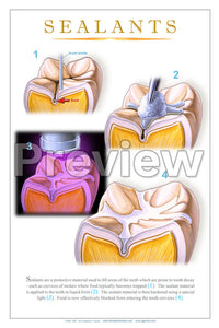 Sealants Wall Chart