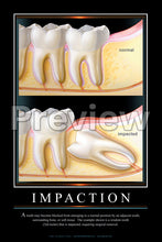 Load image into Gallery viewer, Impaction Wall Chart