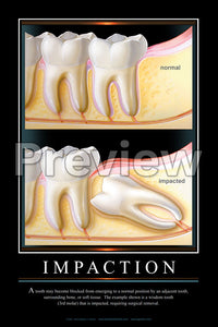 Impaction Wall Chart