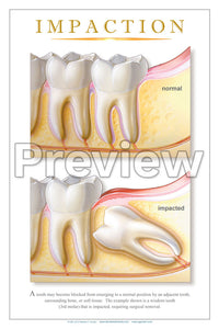 Impaction Wall Chart