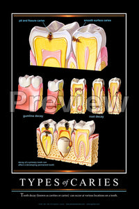 Types of Caries Wall Chart