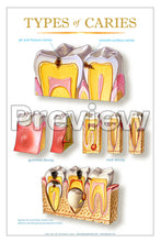 Load image into Gallery viewer, Types of Caries Wall Chart