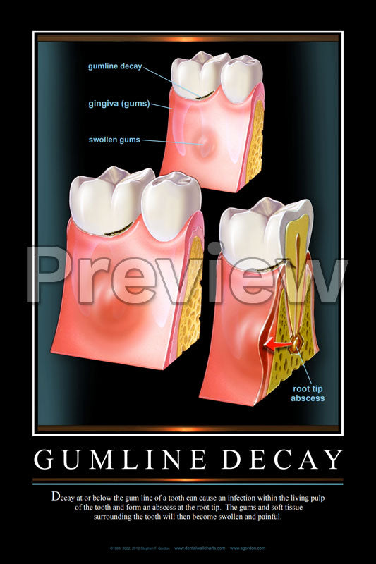 Gumline Decay Wall Chart