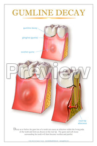 Gumline Decay Wall Chart