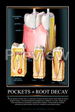 Load image into Gallery viewer, Pockets &amp; Root Decay Wall Chart