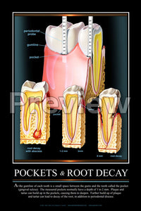 Pockets & Root Decay Wall Chart