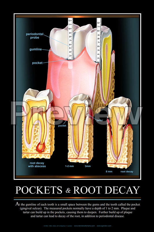 Pockets & Root Decay Wall Chart