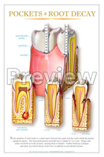 Load image into Gallery viewer, Pockets &amp; Root Decay Wall Chart