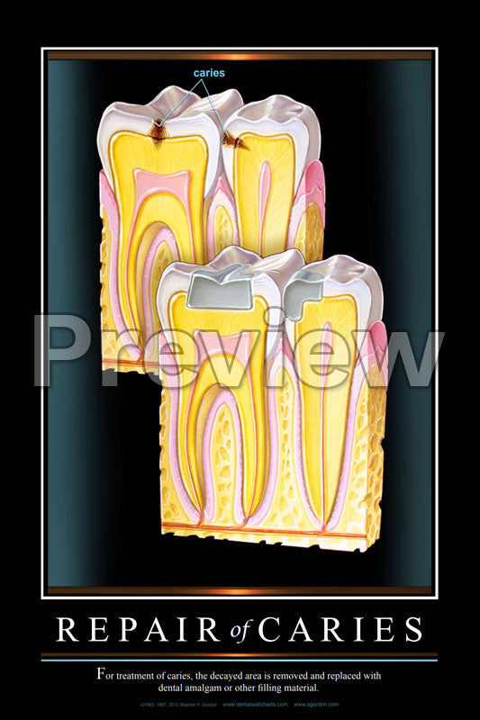 Repair of Caries Wall Chart