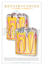 Load image into Gallery viewer, Repair of Caries Wall Chart