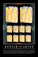 Load image into Gallery viewer, Repair of Caries #2 Wall Chart