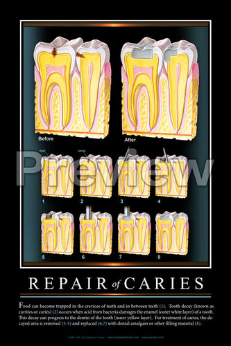 Repair of Caries #2 Wall Chart