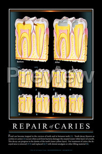 Repair of Caries #2 Wall Chart