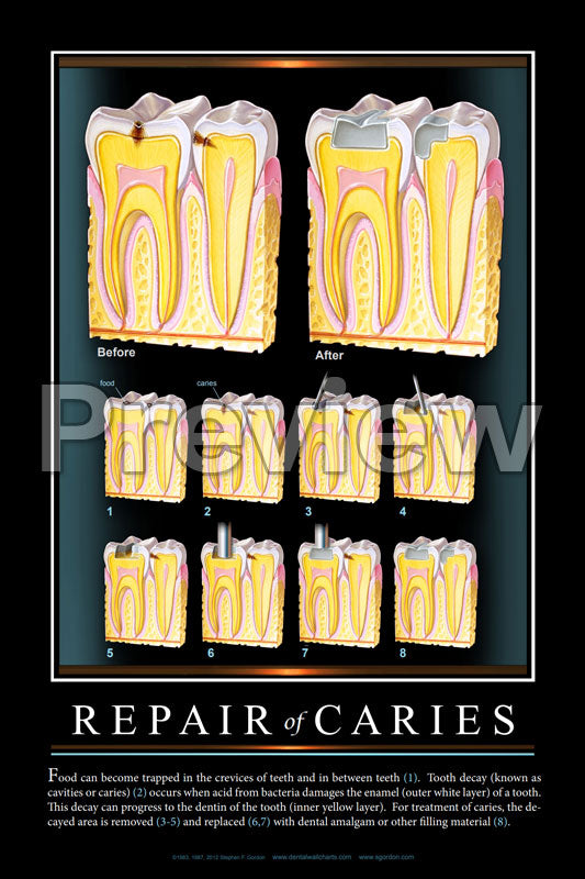Repair of Caries #2 Wall Chart