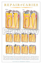 Load image into Gallery viewer, Repair of Caries #2 Wall Chart