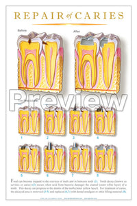 Repair of Caries #2 Wall Chart