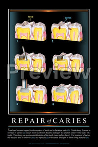 Repair of Caries #3 Wall Chart