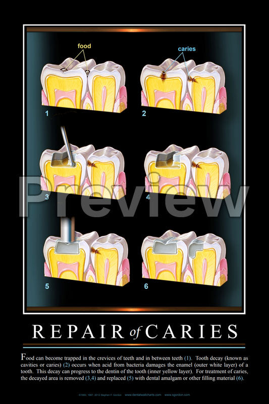Repair of Caries #3 Wall Chart