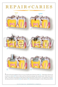 Repair of Caries #3 Wall Chart