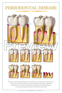 Periodontal Disease Wall Chart