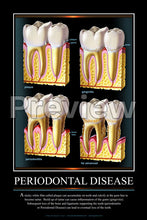 Load image into Gallery viewer, Periodontal Disease #2 Wall Chart