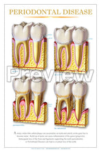 Load image into Gallery viewer, Periodontal Disease #2 Wall Chart