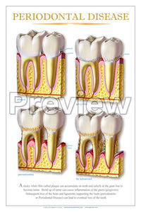 Periodontal Disease #2 Wall Chart