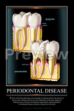 Load image into Gallery viewer, Periodontal Disease #3 Wall Chart