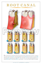 Load image into Gallery viewer, Root Canal Wall Chart