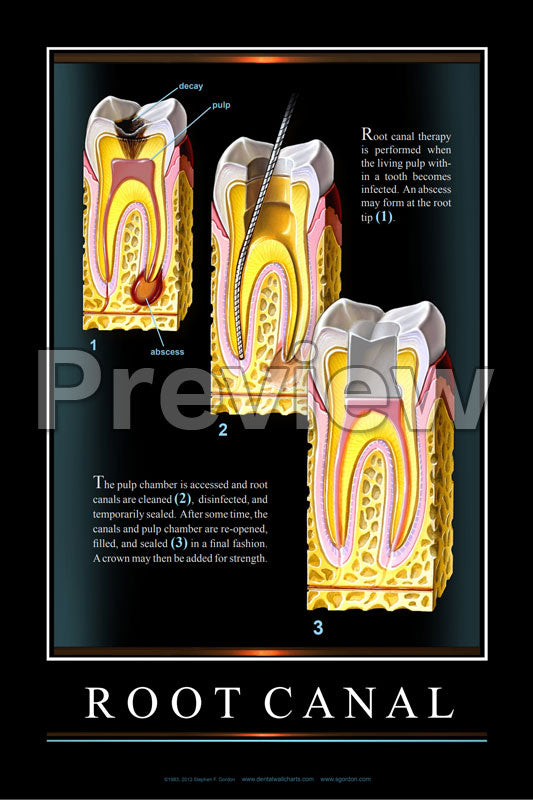 Root Canal #2 Wall Chart – Dental Flip Charts by Stephen F. Gordon