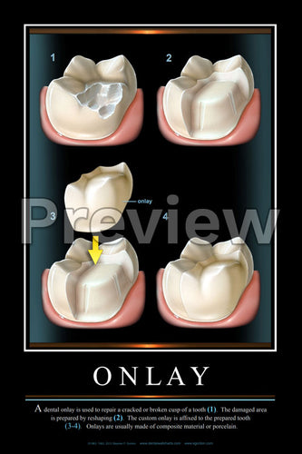 Onlay Wall Chart