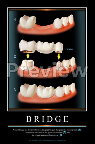 Bridge Wall Chart